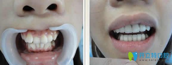 長沙牙大夫口腔周權牙齒矯正案例效果圖
