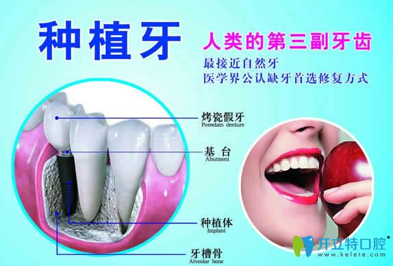 一顆進(jìn)口種植牙要多少錢(qián)？2024全新國(guó)內(nèi)種植牙價(jià)格表曝出