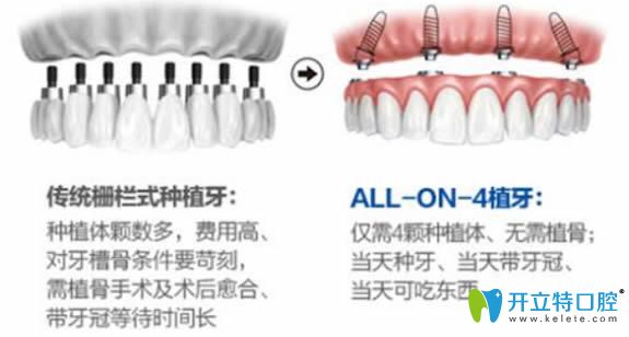 全口種植牙的價(jià)格需要多少錢(qián),有allon4/6即刻種植牙費(fèi)用詳情