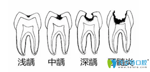 牙壞了一半爛掉了，這樣的蟲牙是補好還是拔好？