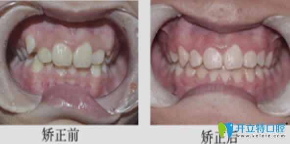 寧波尚善口腔牙齒矯正案例效果圖