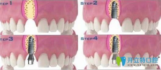 開立特口腔網(wǎng)牙齒種植圖解