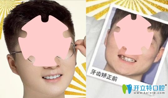 去珠海愛思特口腔做牙齒不齊、個(gè)別反頜矯正案例對比圖