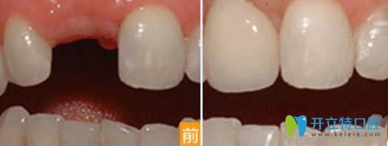 寧波壹加壹口腔茅來(lái)發(fā)主任單顆種植牙效果圖