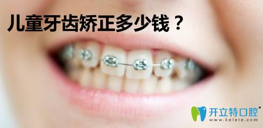 兒童牙齒矯正的費(fèi)用需要多少錢?公布6-15歲兒童箍牙價(jià)格表