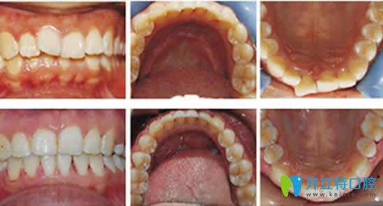 寧波協(xié)禾口腔牙齒矯正前后對比圖