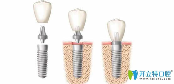 詳解什么是種植牙?關(guān)于種植牙的知識及牙齒種植價格大解析