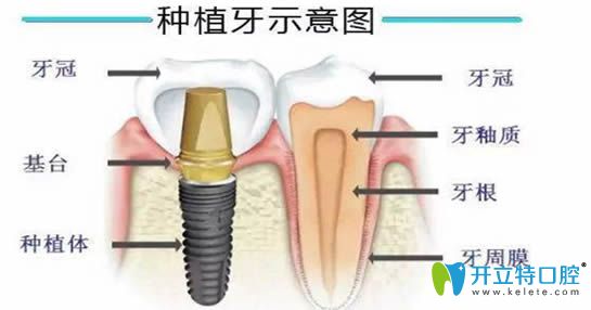 種植牙示意圖