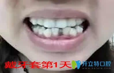 我在重慶嘉悅口腔做牙齒稀疏隱形矯正180天的效果分享