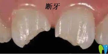 牙醫(yī)答疑:斷牙如何修復(fù)?牙齒斷了一半用樹(shù)脂修補(bǔ)還是美牙冠