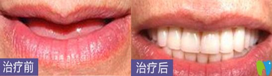 深圳哪家種植牙好？看深圳鵬程口腔種植牙案例