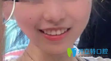 在<!--<i data=20240703-sp></i>-->口腔做完不拔牙矯正18個月后正畸效果
