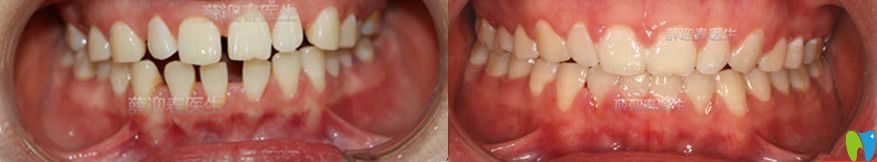 半隱形陶瓷矯正前后對比圖
