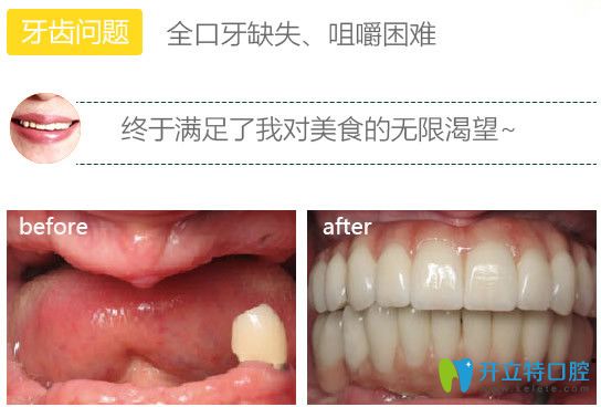 北極星種植牙前后對(duì)比圖