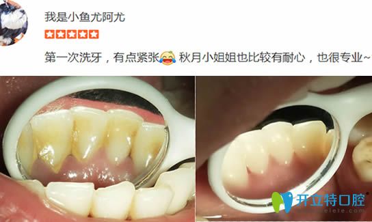 顧客在洛陽拜博洗牙前后對(duì)比效果圖