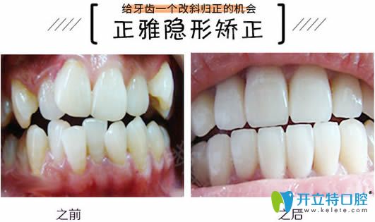 牙齒過度擁擠佩戴正雅矯正器13個月前后對比效果