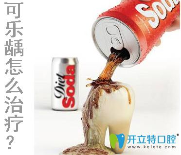 求問可樂齲怎么治療？專業(yè)解答可樂牙的治療費用和方法