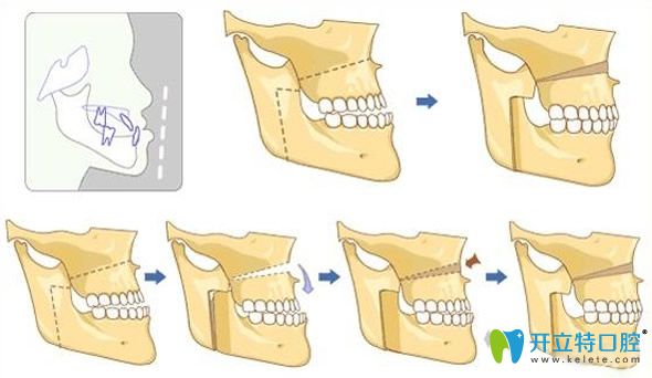地包天牙齒矯正移動(dòng)過程圖