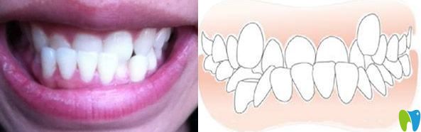 地包天牙齒形成的原因及矯正方法