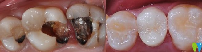 南昌安植雅口腔萬(wàn)威醫(yī)生根管治療案例