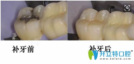 麗江錦美口腔3m z350樹脂補(bǔ)牙前后對比照