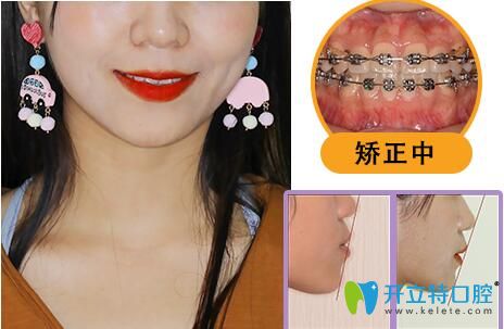 齊美口腔地包天矯正前后效果對(duì)比照片