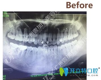 矯正前拍攝的CT