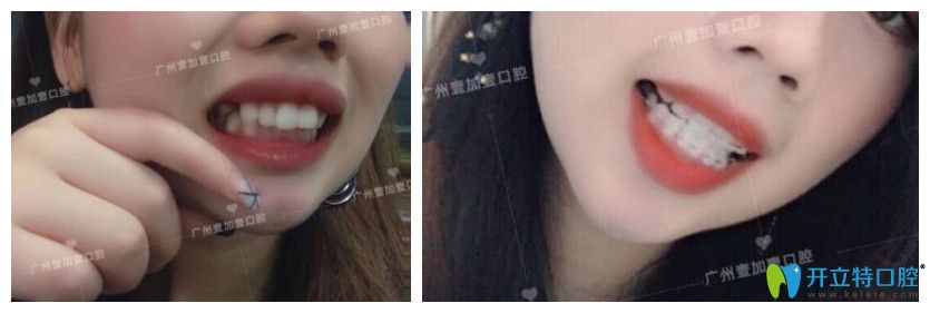 廣州壹加壹齙牙、牙齒擁擠不齊矯正案例效果前后對比照片