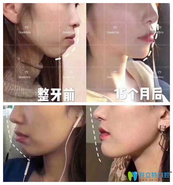廣州壹加壹矯正牙齒好嗎？小姐姐在壹加正畸打卡記錄公開