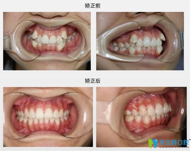 北極星口腔金屬托槽矯正效果