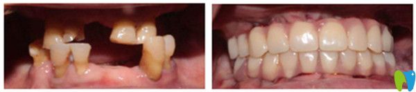 All-on-4全口種植牙前后對(duì)比圖