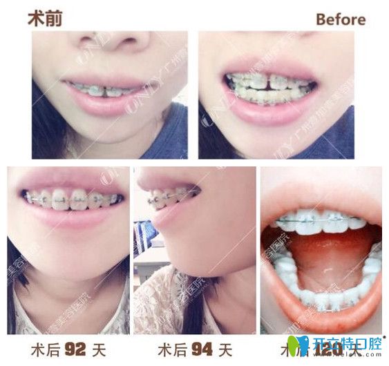 壹加壹齙牙，門牙縫隙矯正過(guò)程中牙齒變化圖