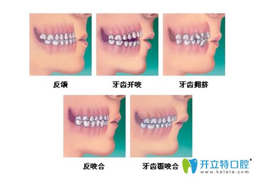 寧波恒美口腔顧俞凱醫(yī)生介紹牙齒矯正的年齡