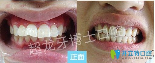 超龍牙博士口腔齙牙矯正案例圖