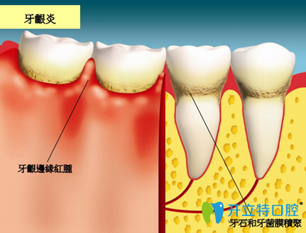 <!--<i data=20240703-sp></i>-->億大口腔劉俊琨醫(yī)生介紹牙齦炎的治療方法