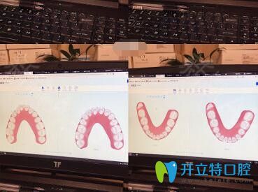 我在<!--<i data=20240703-sp></i>-->億大口腔做牙齒矯正前檢查