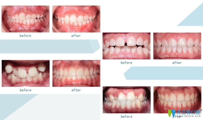 伊爾意口腔矯正牙齒案例效果分享