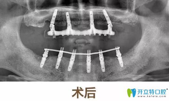 65歲顧客在常州北極星口腔做半口種植牙后效果