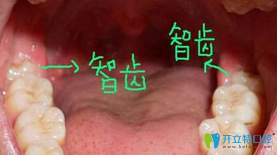 智齒長(zhǎng)歪了你將會(huì)面臨這兩大麻煩:智齒冠周炎和三叉神經(jīng)痛!