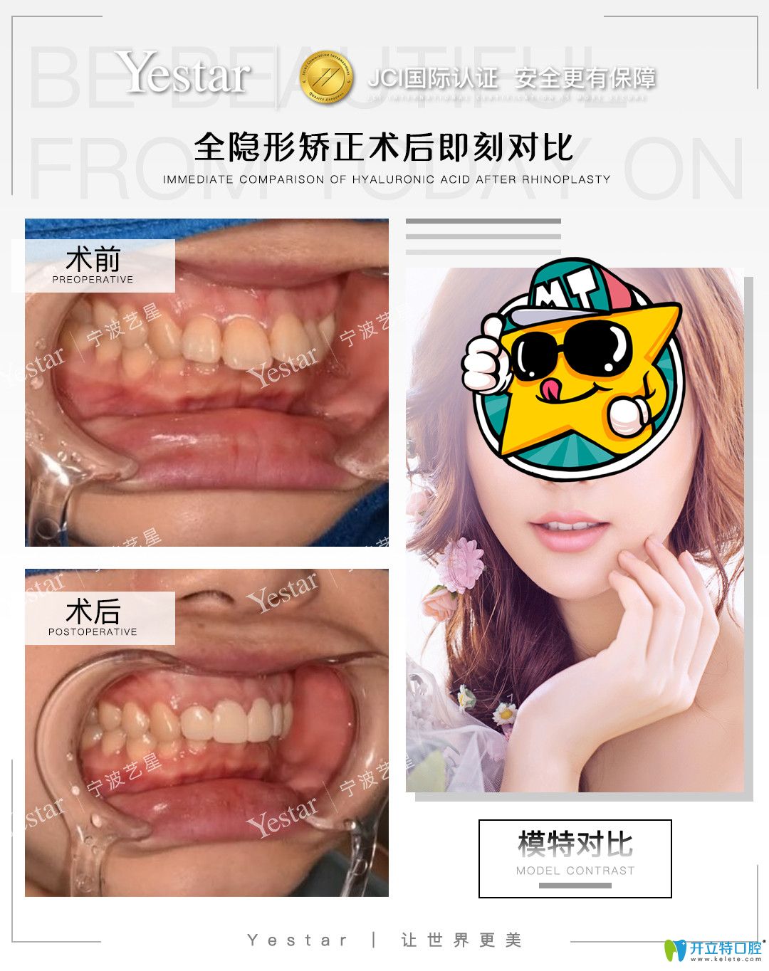藝星口腔門(mén)牙外翻采用隱適美矯正的<span style=