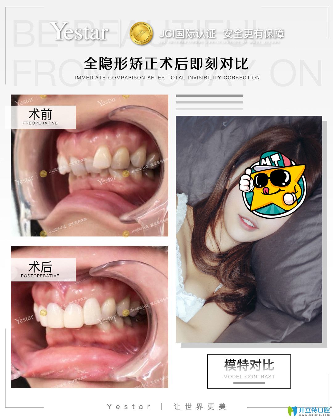 在寧波藝星口腔戴隱形牙套是什么感受，真實(shí)正畸經(jīng)驗(yàn)分享