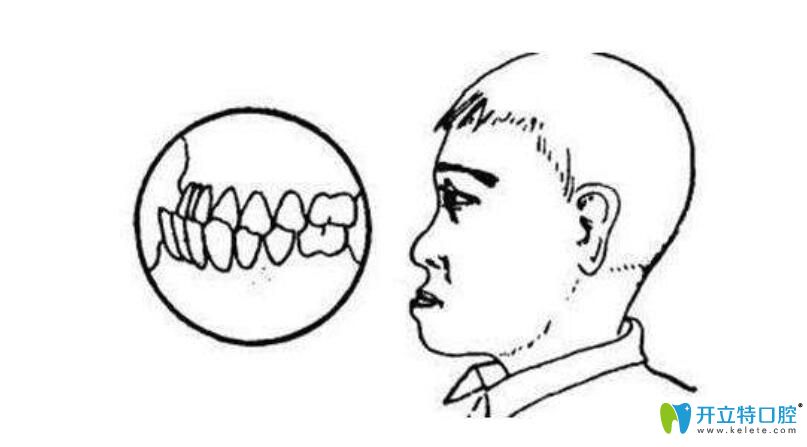 牙齒反合=地包天？如果不幸遭遇牙齒反合是不是一定要矯正
