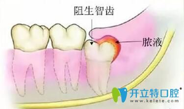 不要再糾結(jié)智齒冠周炎能自愈嗎?教你三個(gè)方法輕松治療疼痛