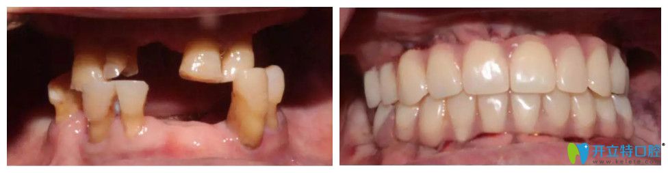 周阿姨在常州北極星口腔做的種植牙前后對(duì)比圖
