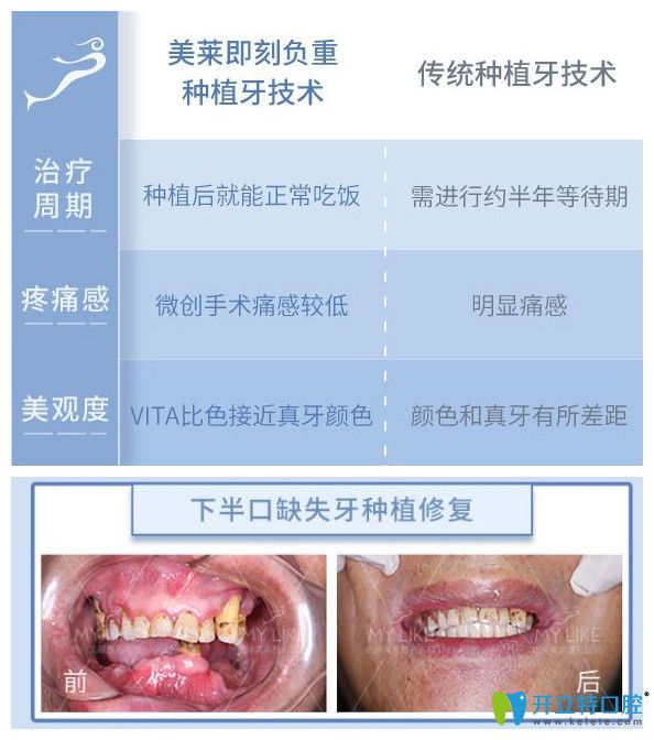 美萊口腔即刻負重種植牙優(yōu)勢多多，還有下半口牙缺失案例效果來證明