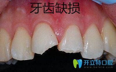 牙齒缺損修復(fù)選擇金屬牙冠、烤瓷牙冠和全瓷牙冠哪個好？