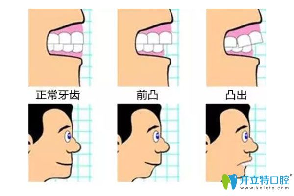 牙齒不同程度矯正后對比圖