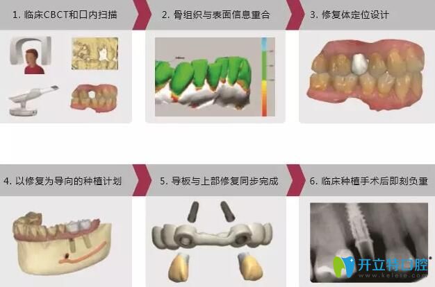 數(shù)字化導(dǎo)板導(dǎo)航種植技術(shù)過程