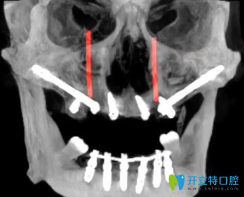 TPP穿翼板種植技術(shù)