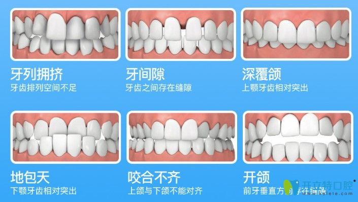 隱形牙套和鋼絲牙套哪個(gè)矯正效果好